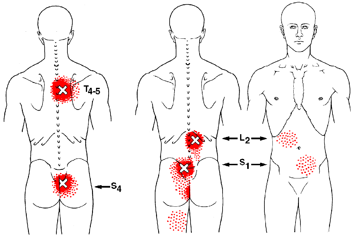 Multifidi The Trigger Point Referred Pain Guide